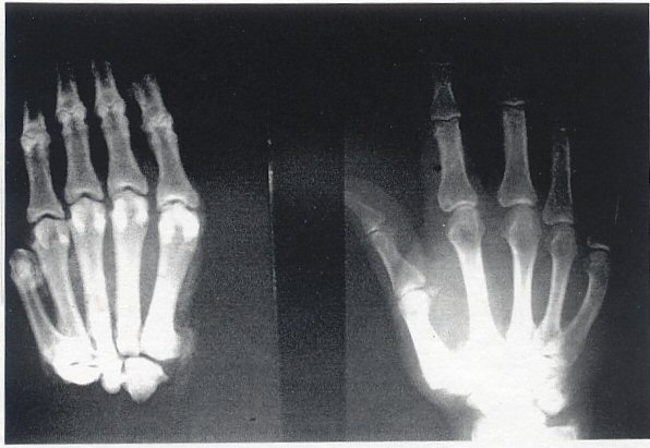 x ray hand. is promoting the X-Ray as